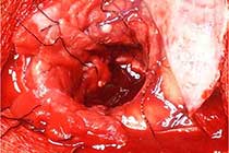 Intra OP ,After Excising The Granuloma