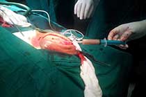 Intaop Scalp Abscess