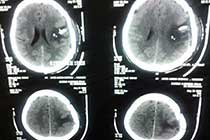 Brain TB Granuloma Post OP CT Scan