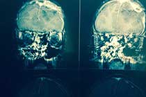 Post OP X-Ray of Hartshill Loop