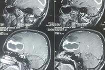 Brain Abscess Preop MRI 2