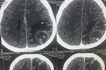 Brain Abscess PRE OP