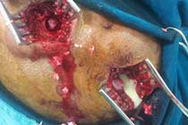 Brain Abscess Intraop 2