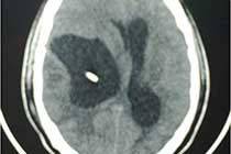 Brain Abscess Following Shunt