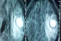PRW OP MRI of TB Granuloma