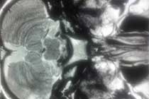 Post OP Cerebellar Abscess