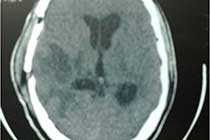 Post OP Brain Abscess