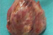 Intraop Specimen of Granuloma