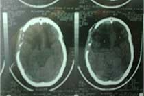 Post OP CT of Bifrontal Contusion