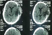 Bifrontal Contusion Pre OP