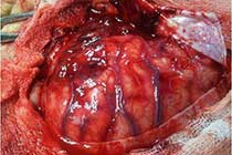 Brain Abscess Post OP 2 Clinical