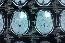 Brain Abscess Post OP 2 Clinical