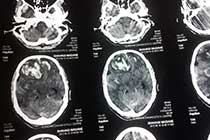 Brain Abscess Post OP 2 Clinical