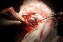 Brain Abscess Post OP 2 Clinical