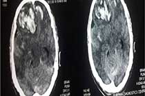 Brain Abscess Post OP 2 Clinical