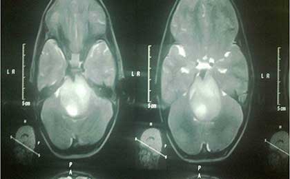 Brain Stem Glioma 2