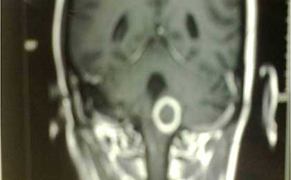 Tuberculoma of cervicomedullary region