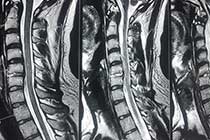 cervical microdiscectomy post op mri