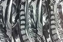 cervical microdiscectomy pre op