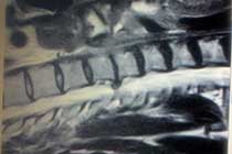 cervical microdiscectomy pre op