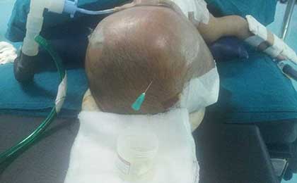 Hydrocephalus