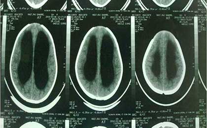 Hydrocephalus