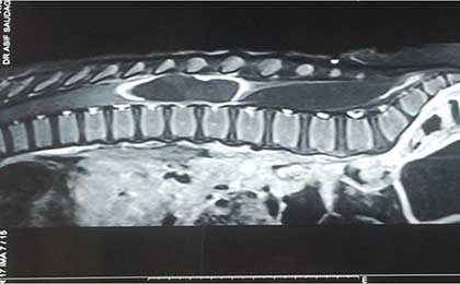 Intraventricular Haemorrhage 