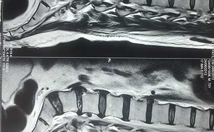 Lumbar Disc
