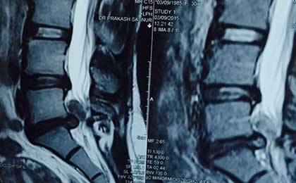 Lumbar Disc
