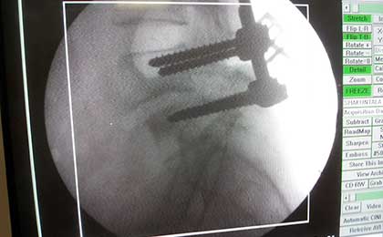 Spine Fixation Lumbar Spine