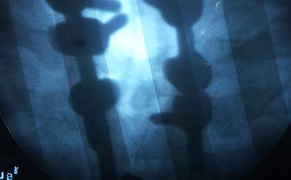Spine Fixation Lumbar Spine