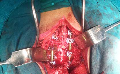 Spine Fixation Lumbar Spine