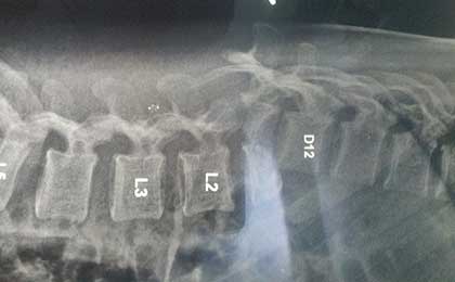 Spine Fixation Lumbar Spine