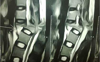 Spine Fixation Lumbar Spine