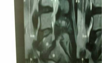 Spine Fixation Lumbar Spine