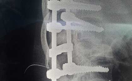 Spine Fixation Lumbar Spine