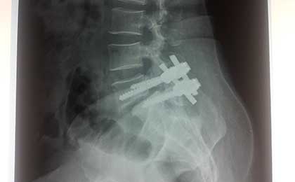 Spine Fixation Lumbar Spine